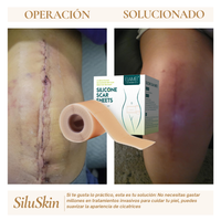SiluSkin: Recupera Tu Piel Sin Marcas